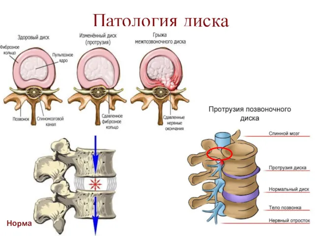 Патология диска Норма