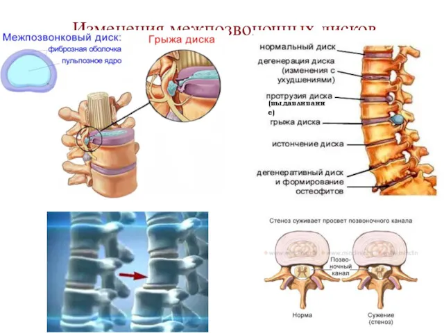 Изменения межпозвоночных дисков (выдавливание)