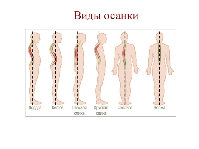 Виды осанки