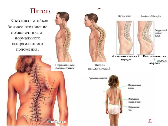 Патологические изгибы Сколиоз - стойкое боковое отклонение позвоночника от нормального
