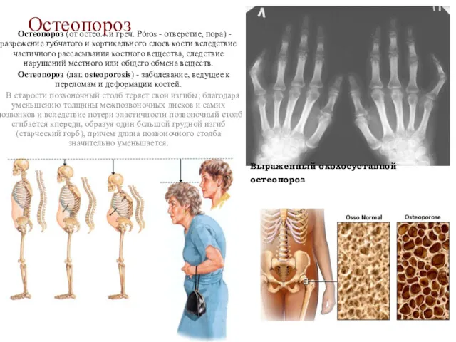 Остеопороз Остеопороз (от остео…и греч. Póros - отверстие, пора) -