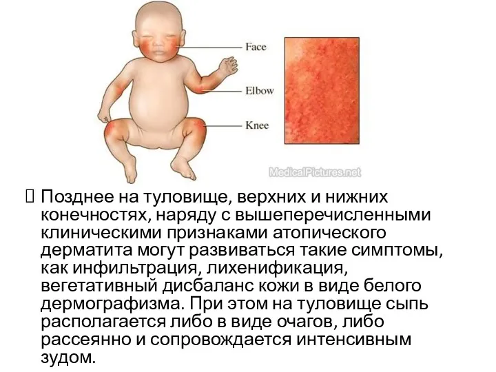 Позднее на туловище, верхних и нижних конечностях, наряду с вышеперечисленными