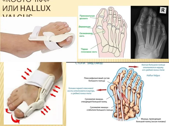 «КОСТОЧКА» ИЛИ HALLUX VALGUS