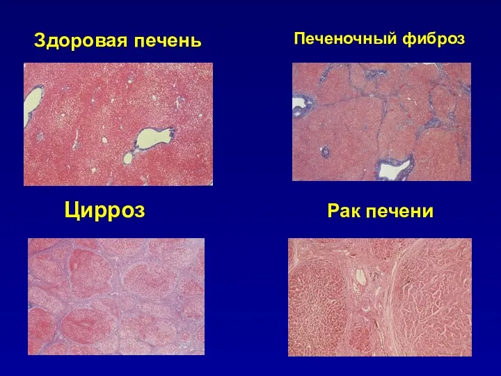 Здоровая печень Печеночный фиброз Цирроз Рак печени