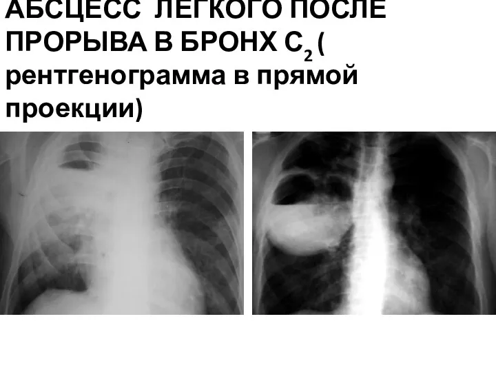 АБСЦЕСС ЛЕГКОГО ПОСЛЕ ПРОРЫВА В БРОНХ С2 ( рентгенограмма в прямой проекции)