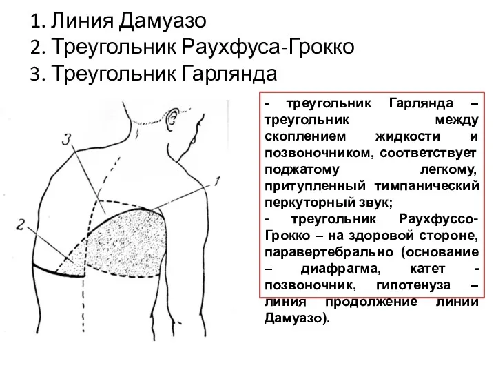 1. Линия Дамуазо 2. Треугольник Раухфуса-Грокко 3. Треугольник Гарлянда -