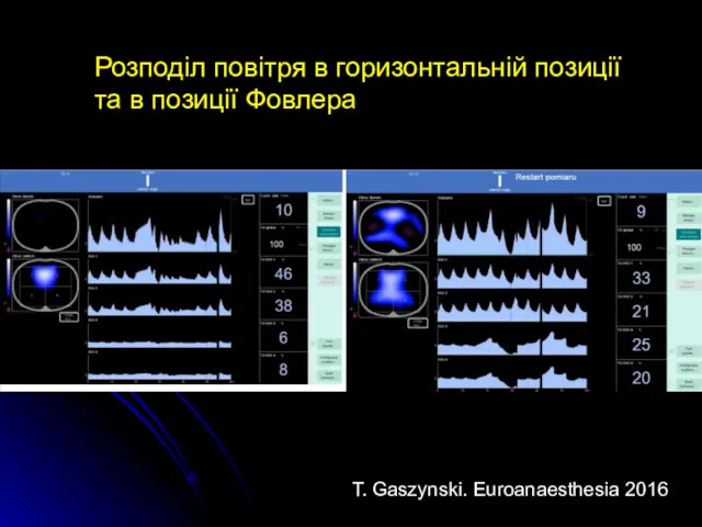 Розподіл повітря в горизонтальній позиції та в позиції Фовлера T. Gaszynski. Euroanaesthesia 2016