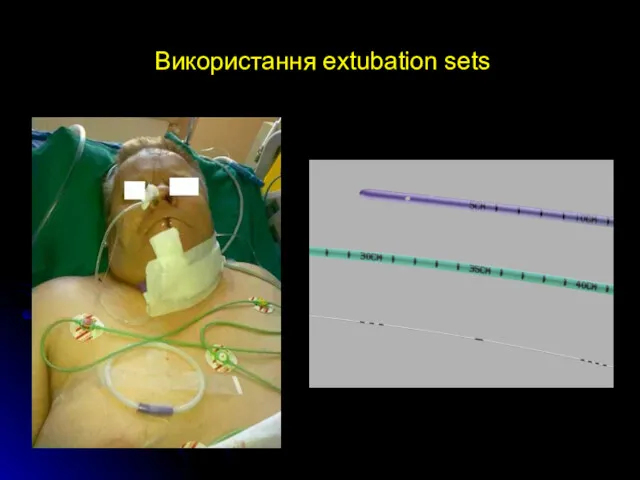 Використання extubation sets