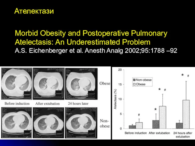 Ателектази Morbid Obesity and Postoperative Pulmonary Atelectasis: An Underestimated Problem