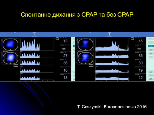 Спонтанне дихання з CPAP та без CPAP T. Gaszynski. Euroanaesthesia 2016