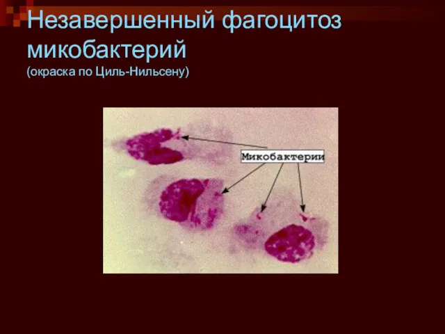 Незавершенный фагоцитоз микобактерий (окраска по Циль-Нильсену)‏