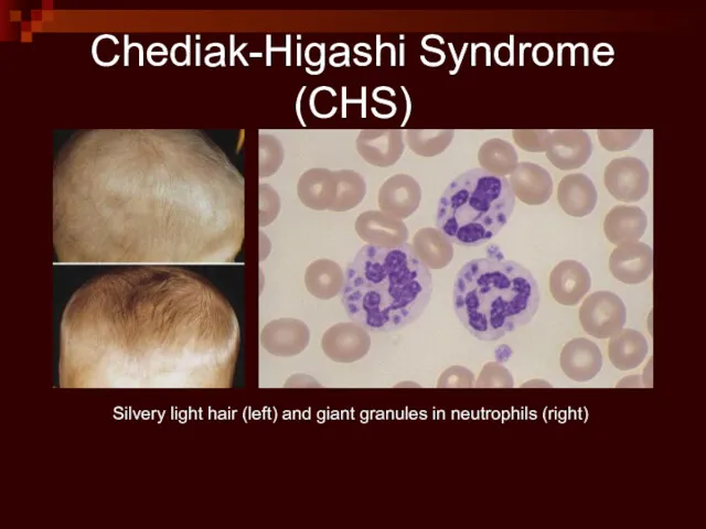 Silvery light hair (left) and giant granules in neutrophils (right) Chediak-Higashi Syndrome (CHS)