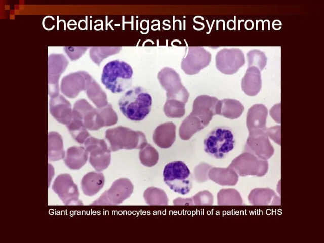 Giant granules in monocytes and neutrophil of a patient with CHS Chediak-Higashi Syndrome (CHS)