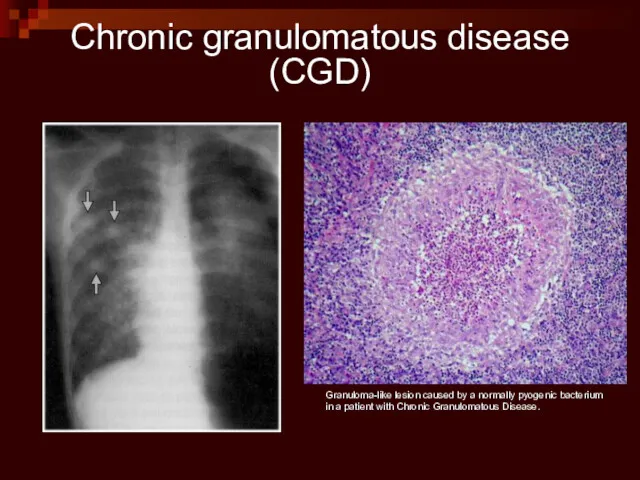 Granuloma-like lesion caused by a normally pyogenic bacterium in a