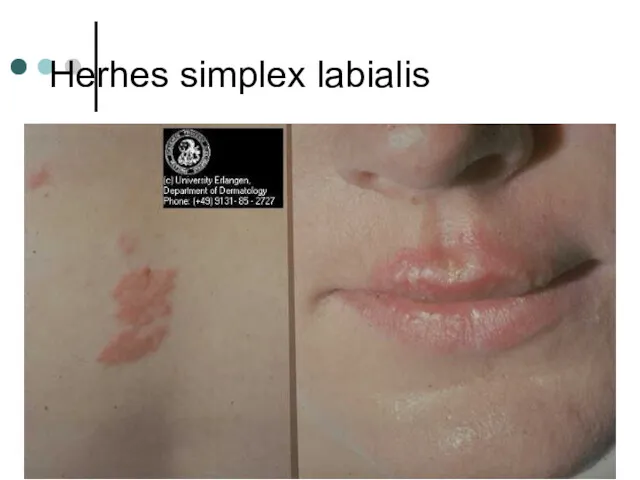 Herhes simplex labialis