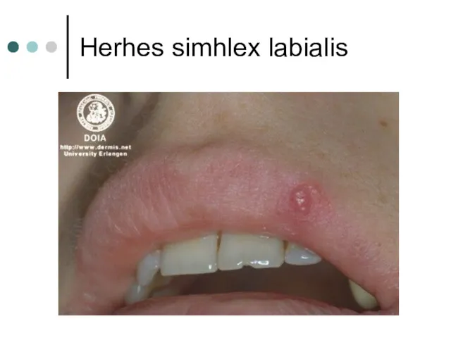 Herhes simhlex labialis