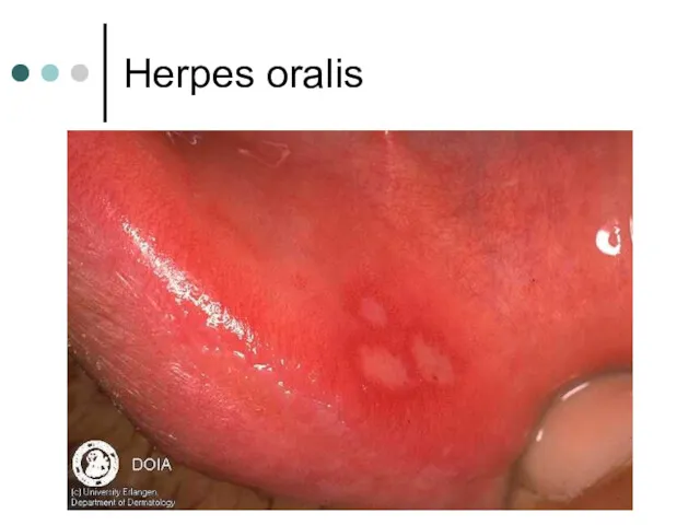Herpes oralis