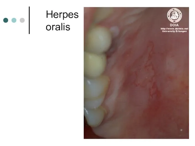 Herpes oralis