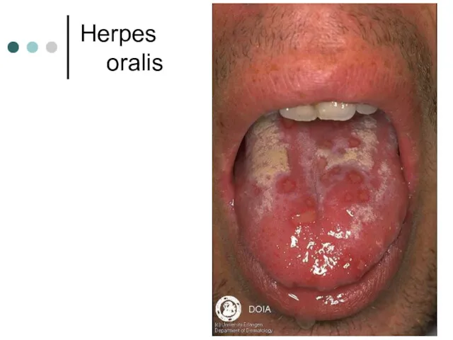 Herpes oralis