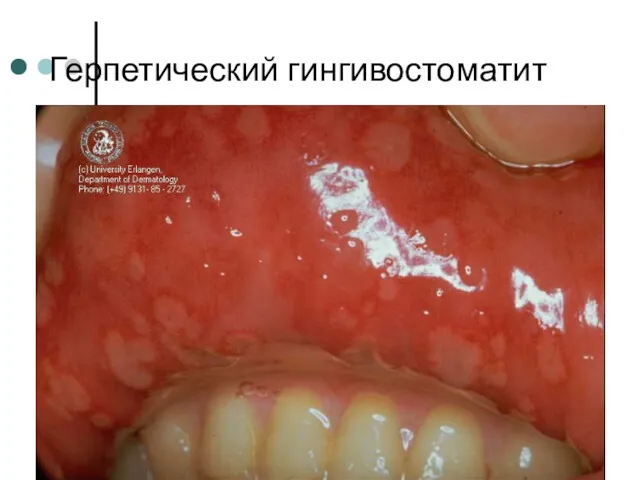 Герпетический гингивостоматит