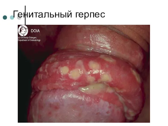 Генитальный герпес