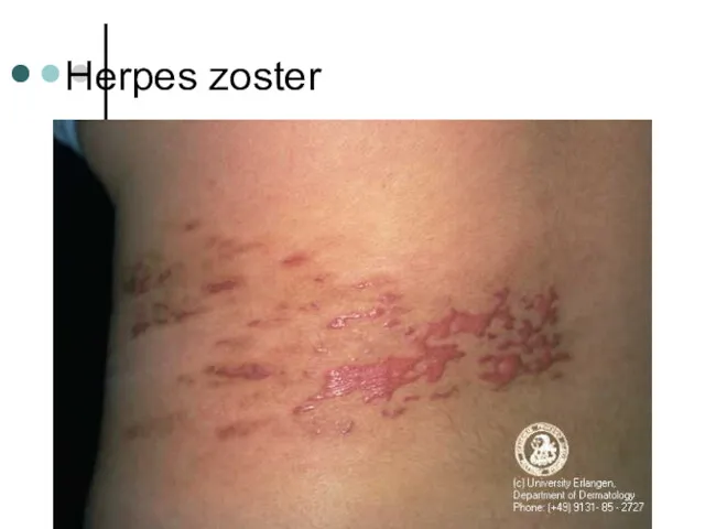 Herpes zoster