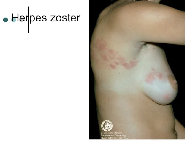 Herpes zoster