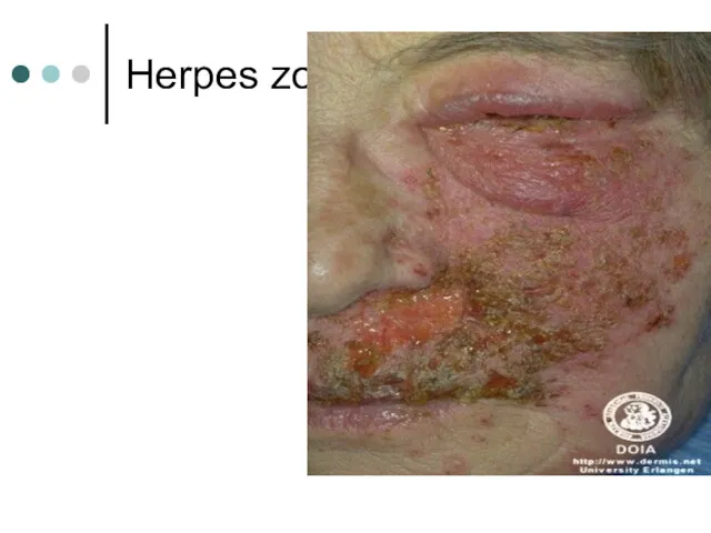 Herpes zoster