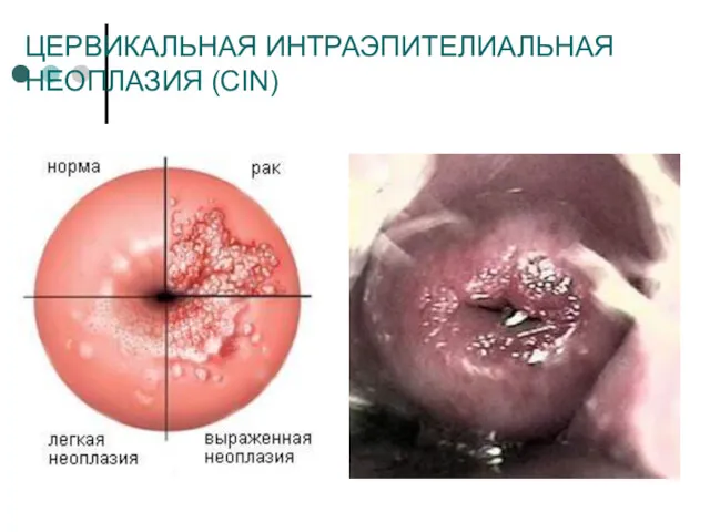 ЦЕРВИКАЛЬНАЯ ИНТРАЭПИТЕЛИАЛЬНАЯ НЕОПЛАЗИЯ (CIN)