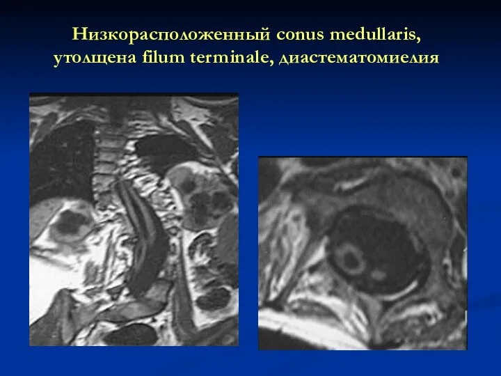 Низкорасположенный conus medullaris, утолщена filum terminale, диастематомиелия