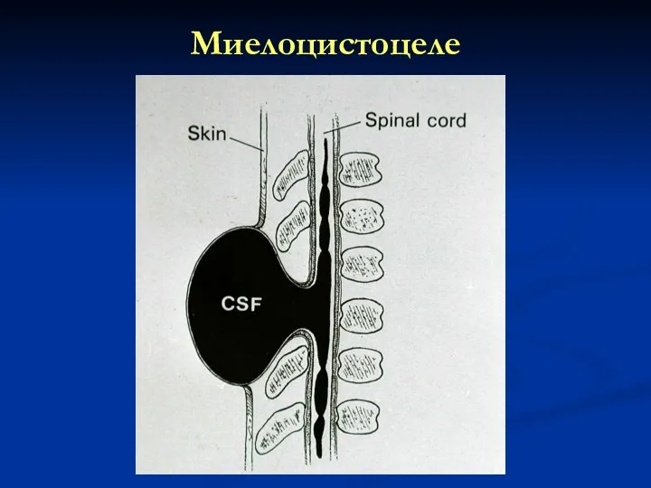 Миелоцистоцеле