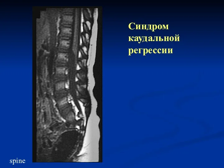 Синдром каудальной регрессии spine