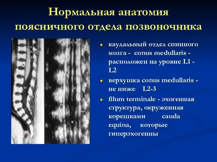Нормальная анатомия поясничного отдела позвоночника каудальный отдел спинного мозга - conus medullaris -