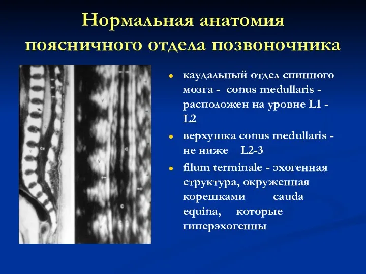 Нормальная анатомия поясничного отдела позвоночника каудальный отдел спинного мозга -