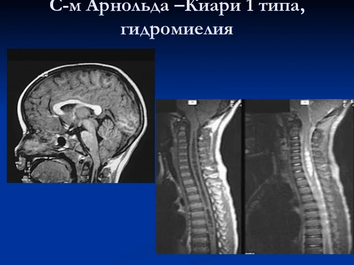 С-м Арнольда –Киари 1 типа, гидромиелия