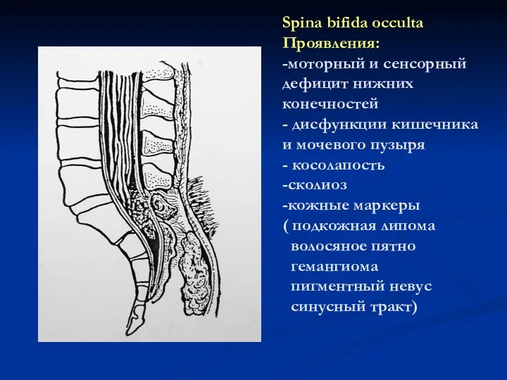 Spina bifida occulta Проявления: -моторный и сенсорный дефицит нижних конечностей - дисфункции кишечника
