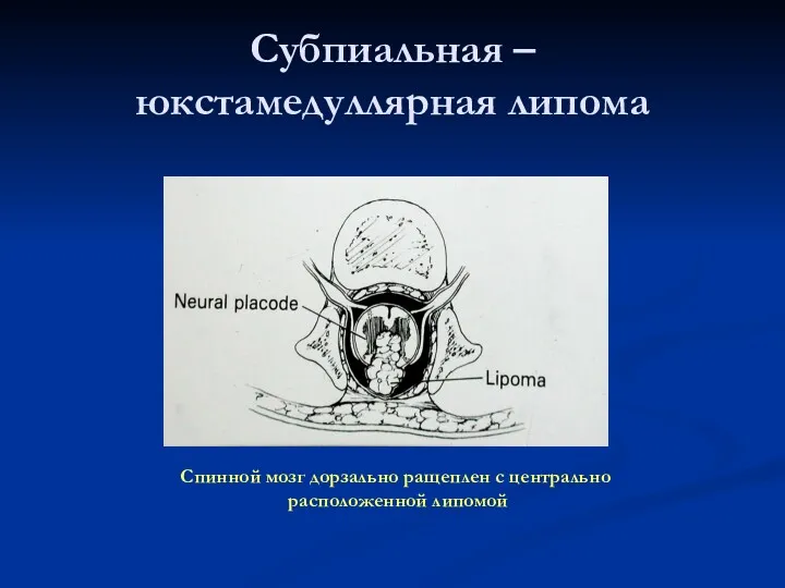 Субпиальная – юкстамедуллярная липома Спинной мозг дорзально ращеплен с центрально расположенной липомой