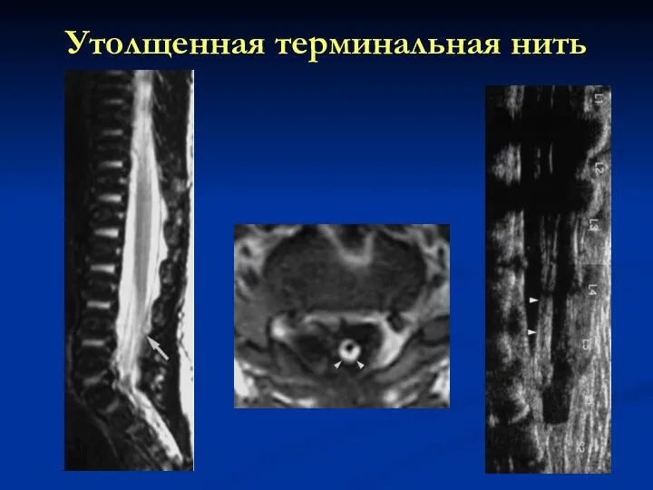 Утолщенная терминальная нить