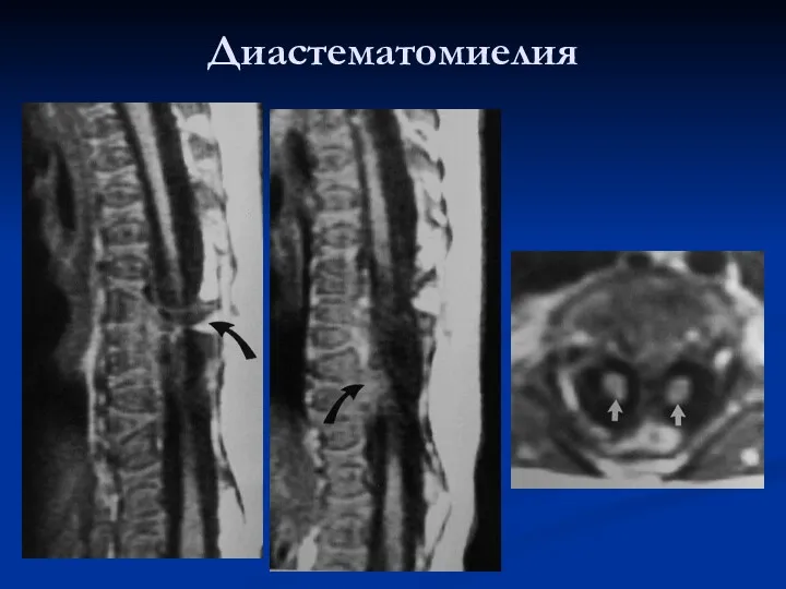 Диастематомиелия