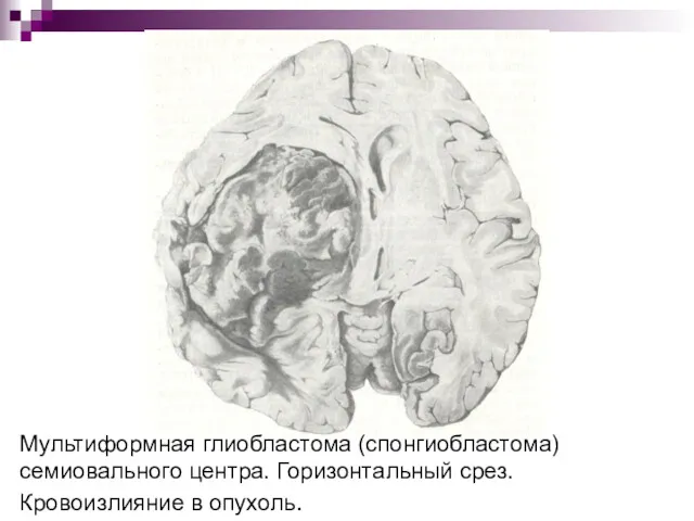 Мультиформная глиобластома (спонгиобластома) семиовального центра. Горизонтальный срез. Кровоизлияние в опухоль.