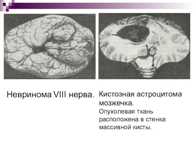 Невринома VIII нерва. Кистозная астроцитома мозжечка. Опухолевая ткань расположена в стенка массивной кисты.