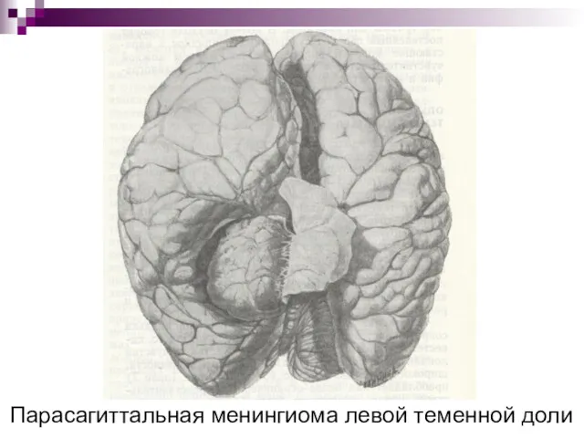 Парасагиттальная менингиома левой теменной доли