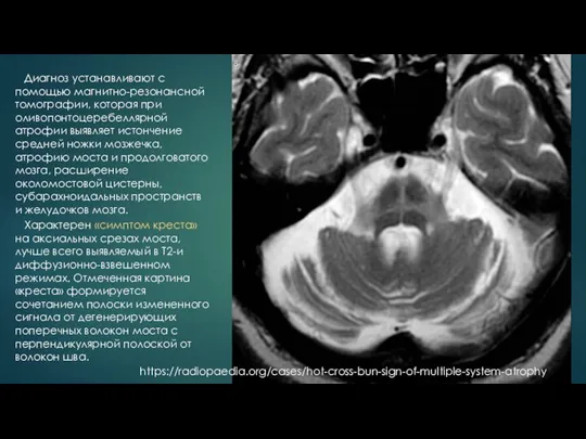 Характерен «симптом креста» на аксиальных срезах моста, лучше всего выявляемый