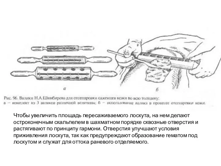 Чтобы увеличить площадь пересаживаемого лоскута, на нем делают остроконечным скальпелем