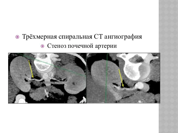 Трёхмерная спиральная CT ангиография Стеноз почечной артерии