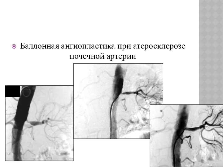 Баллонная ангиопластика при атеросклерозе почечной артерии