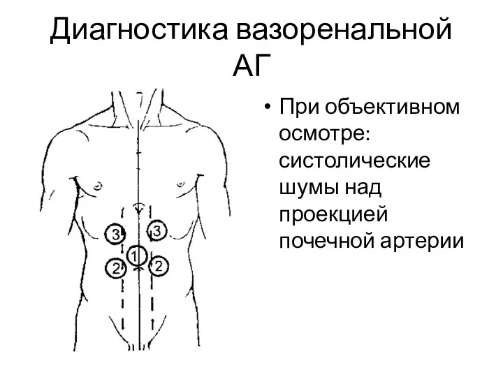 Диагностика вазоренальной АГ При объективном осмотре: систолические шумы над проекцией почечной артерии