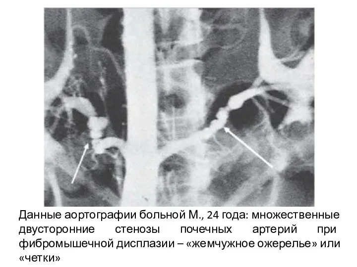 Данные аортографии больной М., 24 года: множественные двусторонние стенозы почечных