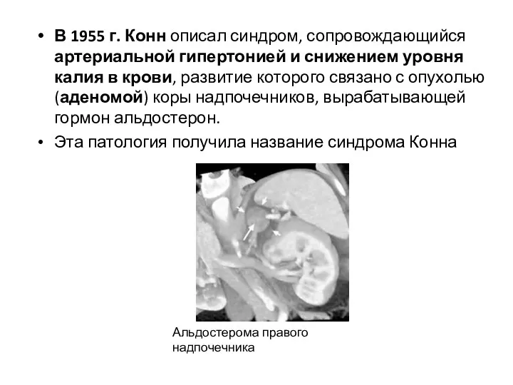 В 1955 г. Конн описал синдром, сопровождающийся артериальной гипертонией и