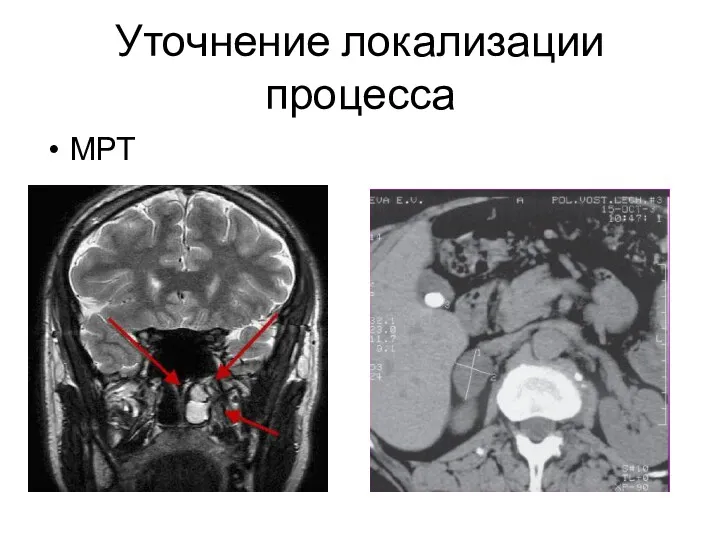 Уточнение локализации процесса МРТ